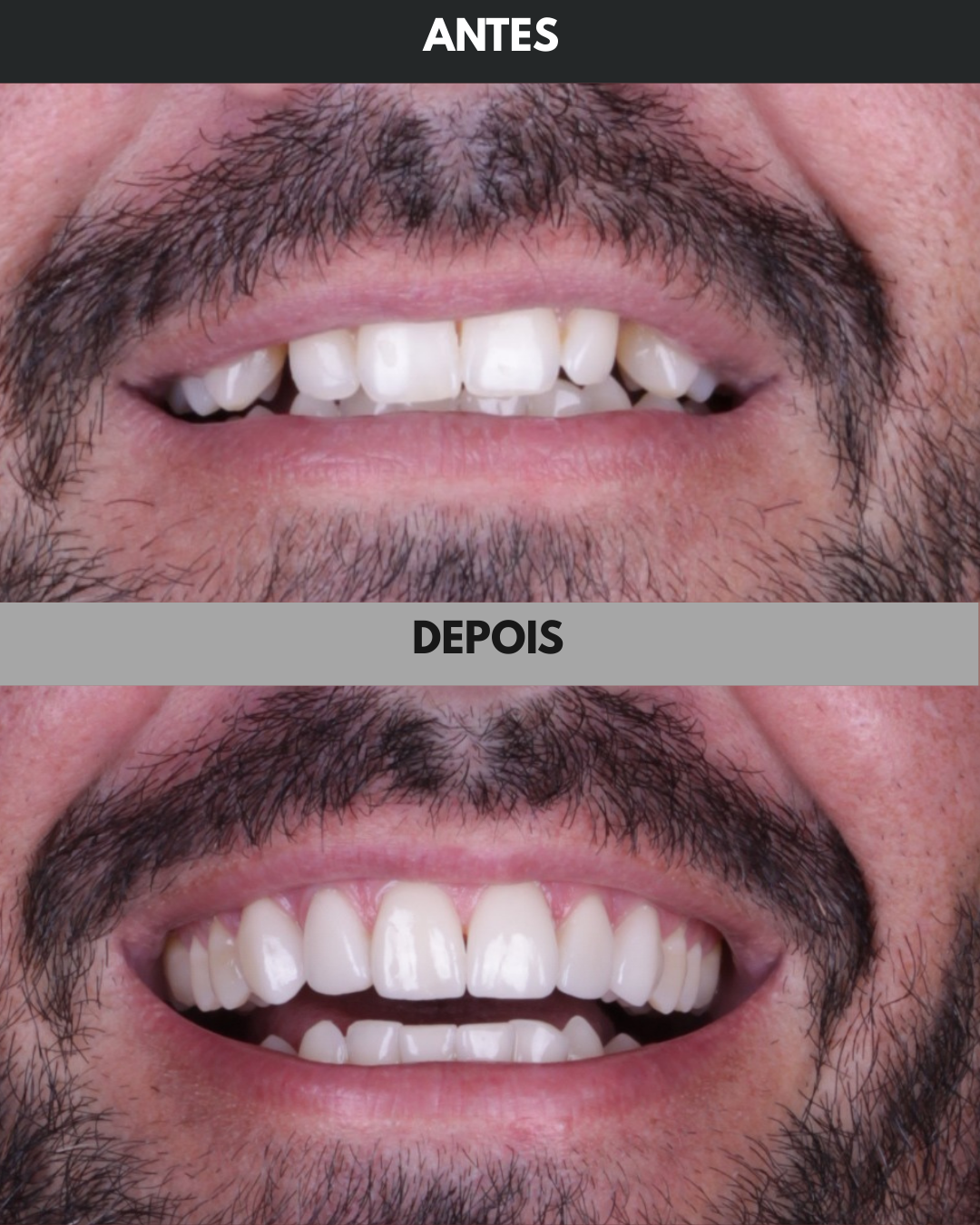 Antes e Depois - 004